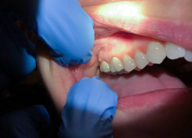 Best Emergency Dental Care for Abscessed Tooth in Carthage, MS
